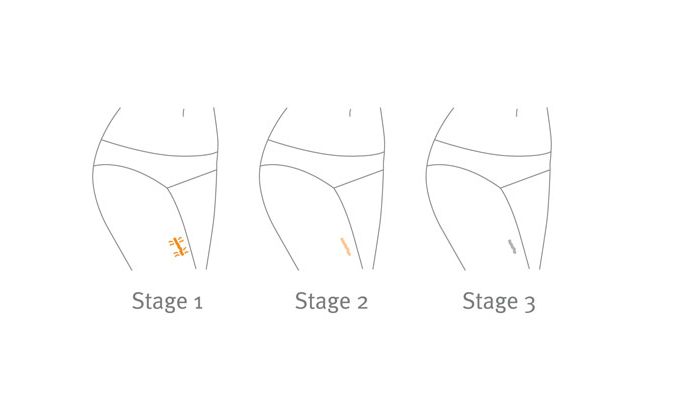 Bio-Oil_Scar_formation_stages.indd